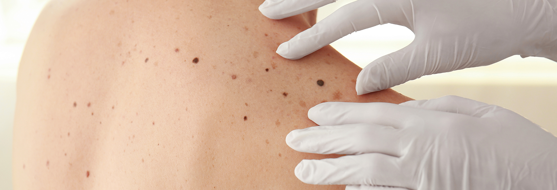 gloved hands examining moles on a shoulder