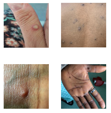 Visual examples of MPV (Monkeypox)