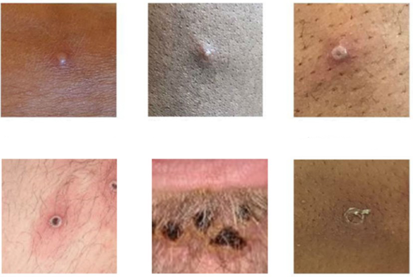 Visual examples of MPV (Monkeypox)